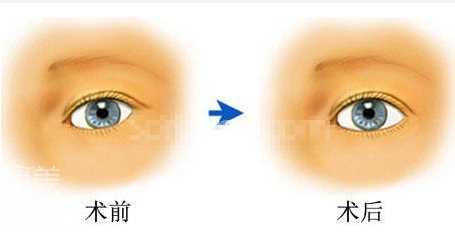 欧式大平行双眼皮如何做?怎样的适合自己