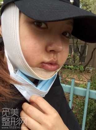 下颌角修复手术 下巴修复手术术后6个月