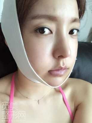 下颌角修复手术 下巴修复手术术后6个月