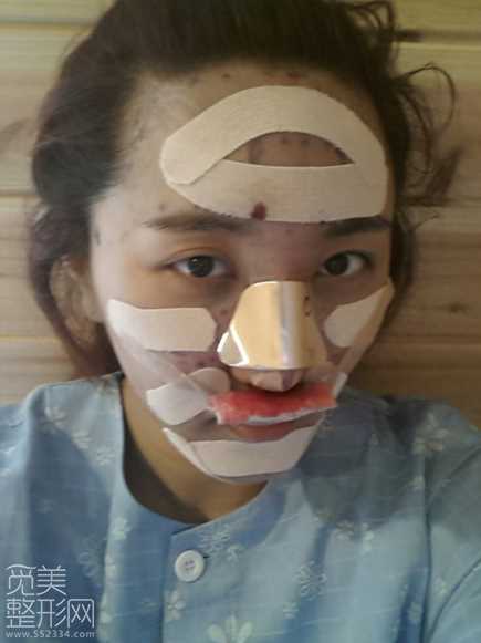 自体脂肪填充后的新娘子