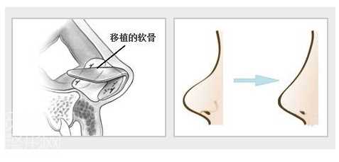 自体耳软骨隆鼻 价格 后遗症 手术优缺点