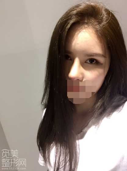 综合隆鼻术后第10天 综合隆鼻手术介绍