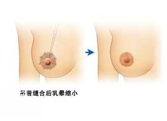 乳晕缩小有什么方法乳晕缩小方法有哪些？