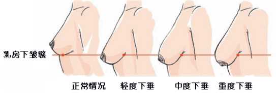 乳房下垂介绍