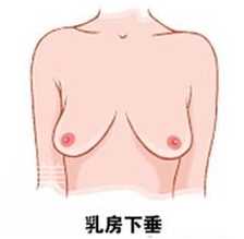 乳房下垂介绍