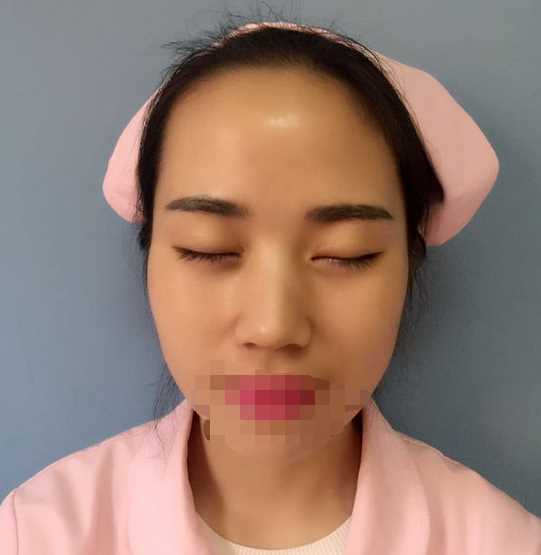全切双眼皮没有留疤,恢复的不错哦