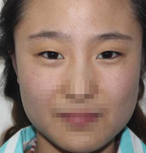 双眼皮,恢复过程没有增生哦