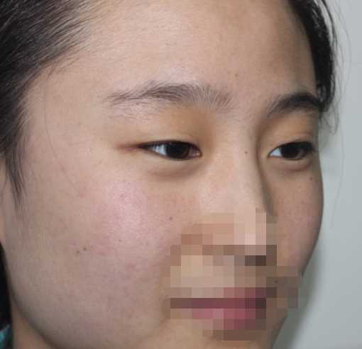 双眼皮,恢复过程没有增生哦