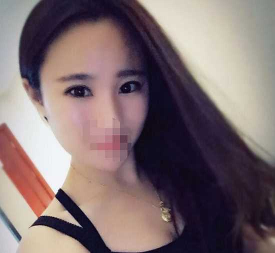 双眼皮,恢复过程没有增生哦