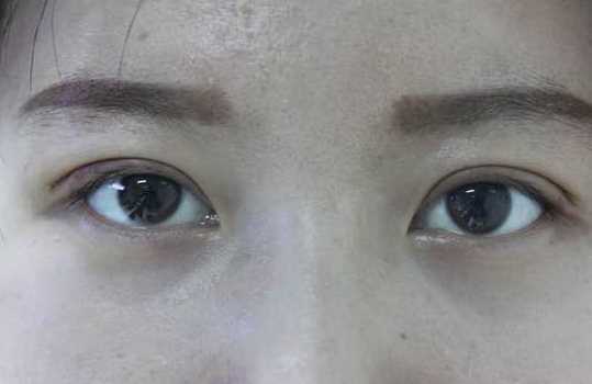 全切双眼皮术后很满意 完美!