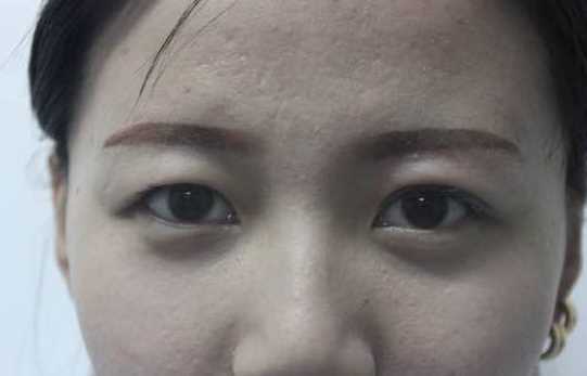 全切双眼皮术后很满意 完美!