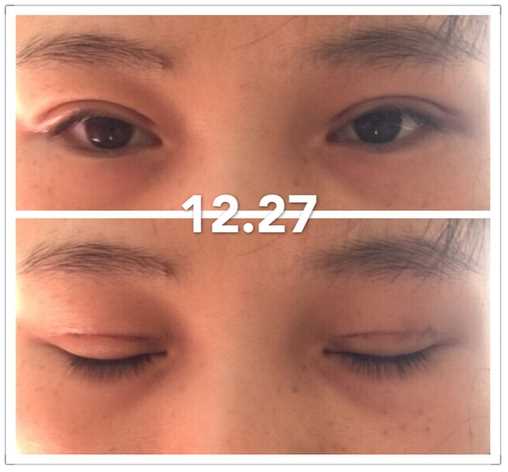 双眼皮术后分享