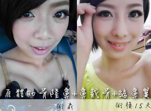 自体肋骨隆鼻,真是好漂亮哟