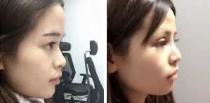 玻尿酸隆鼻日记,分享给大家