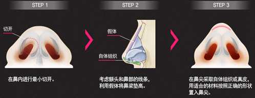 非开放式鼻整形 韩式三段式隆鼻有后遗症？