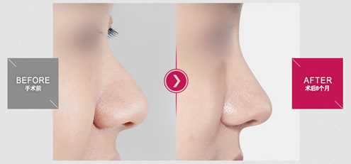 非开放式鼻整形 韩式三段式隆鼻有后遗症？