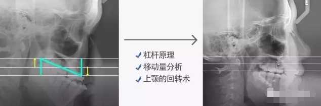 双鄂矫正3个月手术变化