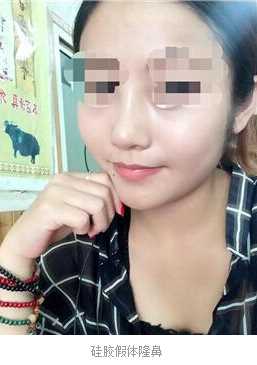 塌鼻子的隆鼻经验分享