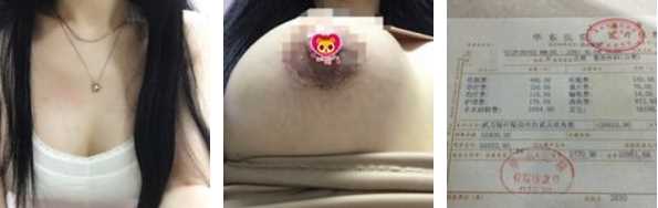 假体隆胸术后案例分享图