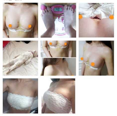 小七妹子的假体隆胸整形日记