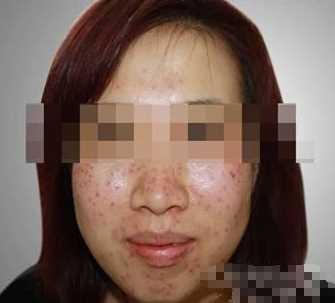 激光去雀斑术后我更自信了