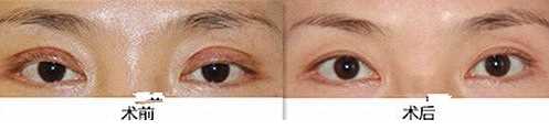全切双眼皮恢复时间是多久？