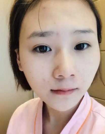 *整形+全切双眼皮