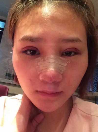 *整形+全切双眼皮