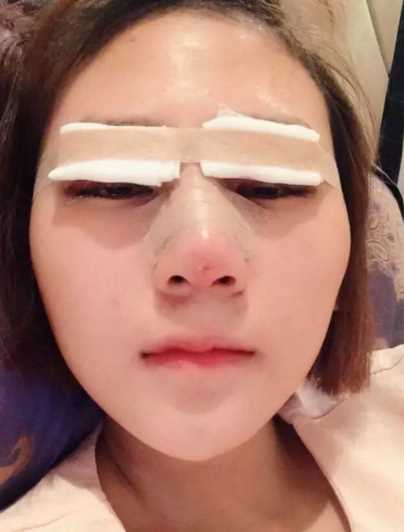 *整形+全切双眼皮