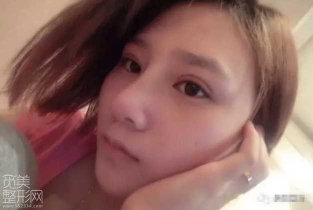 *整形+全切双眼皮