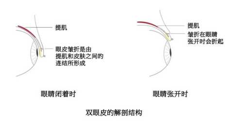 无疤缝合式双眼皮手术