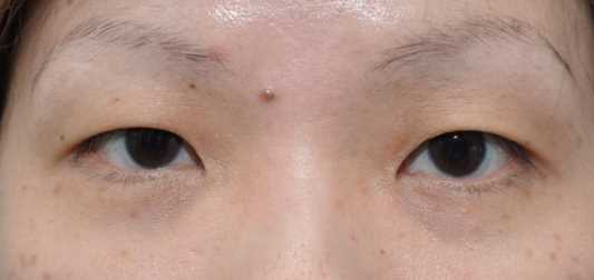 无疤缝合式双眼皮手术