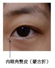 无疤缝合式双眼皮手术