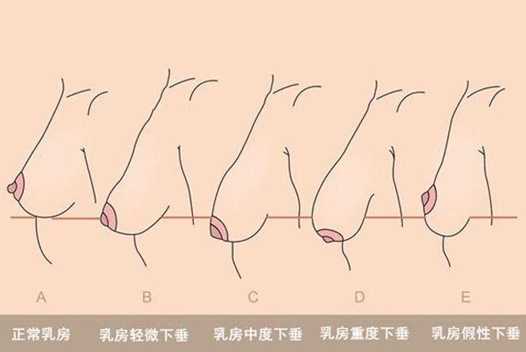 乳房下垂矫正介绍以及改善方法