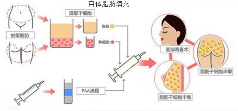 自体脂肪填充范围有哪些以及优缺点