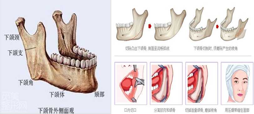 下颌角削骨整形手术介绍