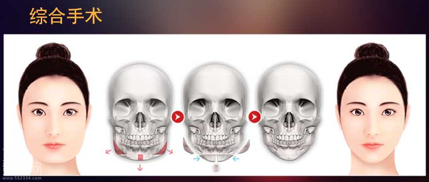 下颌角削骨整形手术介绍
