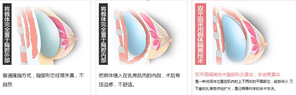 假体隆胸切口有哪些？术后*果怎么样？