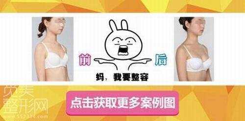 自体脂肪成活率 自体脂肪丰胸的成活率