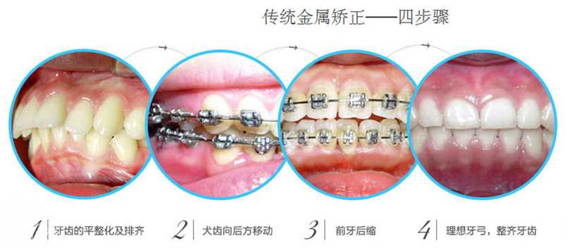 牙齿矫正介绍 传统钢丝矫正价格？