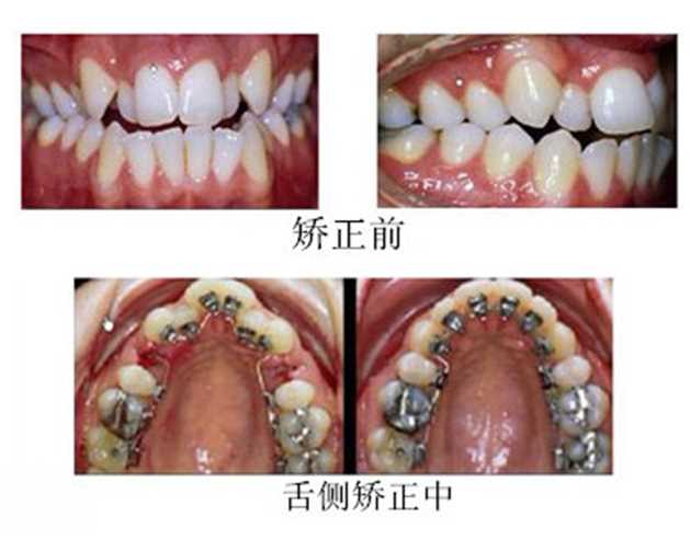 舌侧矫正牙齿-隐性矫正牙齿