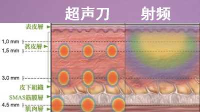 *和热玛吉对比 哪种好？