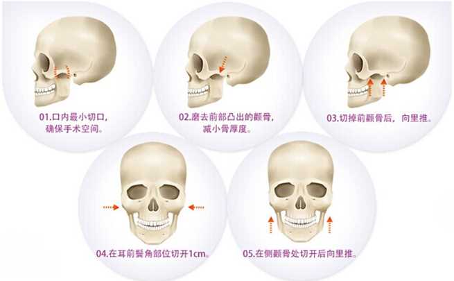 颧骨整形介绍 案例图