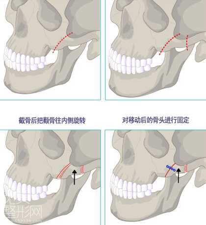 颧骨整形手术介绍！案例图