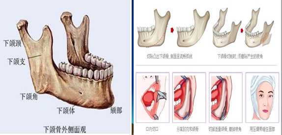 下颌角整形介绍