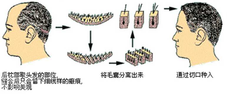 毛发种植原理 技术方法