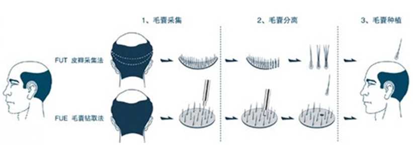 植发手术价格适应人群禁忌人群介绍