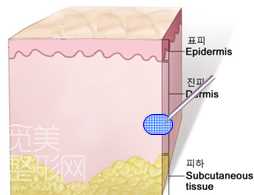 玻尿酸YVOIRE 伊婉 Classic s和Volume s对比