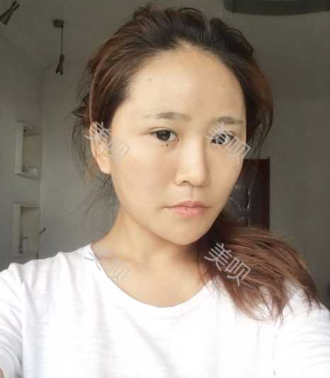 吸脂瘦大腿 自体脂肪填充面部一举两得