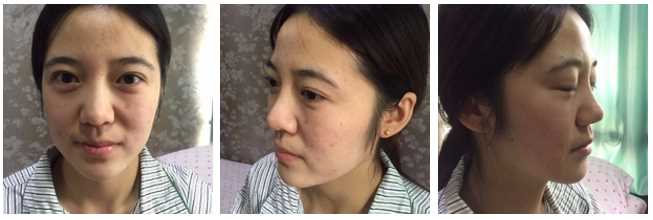 在北京市炫美医疗美容做的自体脂肪填充